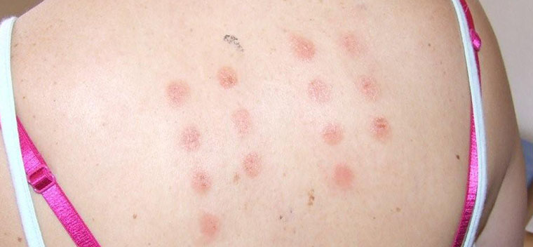 Skin Allergy Evansville